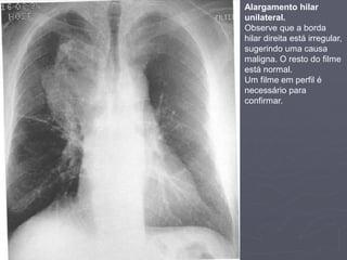 Dr. Emanuel R. Dantas
Alargamento hilar
unilateral.
Observe que a borda
hilar direita está irregular,
sugerindo uma causa
maligna. O resto do filme
está normal.
Um filme em perfil é
necessário para
confirmar.
 