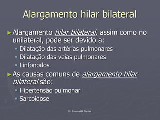 Dr. Emanuel R. Dantas
Alargamento hilar bilateral
►Alargamento hilar bilateral, assim como no
unilateral, pode ser devido a:
▪ Dilatação das artérias pulmonares
▪ Dilatação das veias pulmonares
▪ Linfonodos
►As causas comuns de alargamento hilar
bilateral são:
▪ Hipertensão pulmonar
▪ Sarcoidose
 