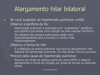 Dr. Emanuel R. Dantas
Alargamento hilar bilateral
► Se você suspeitar de hipertensão pulmonar, então:
1. Observe a periferia do Rx:
1. Hipertensão pulmonar é associada com “podamento” periférico
que significa que existe uma redução na rede vascular periférica.
2. As margens dos campos pulmonares estão mais
hipertransparentes que o normal e o centro mais
hipotransparente.
2. Observe a forma do hilo:
1. É a dilatação da artéria pulmonar que leva ao alargamento hilar
bilateral na hipertensão pulmonar. Os hilos terão a forma convexa.
3. Procure pela causa da hipertensão pulmonar:
1. Procure por sinais de doença pulmonar como DPOC e observe
atentamente a forma do coração por sinais de shunts ou estenose
mitral.
 