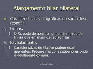 Dr. Emanuel R. Dantas
Alargamento hilar bilateral
► Características radiográficas da sarcoidose
(cont.):
3. Linhas:
1. O Rx pode demonstrar um emaranhado de
linhas que emanam da região hilar.
4. Faveolamento:
1. Características de fibrose podem estar
aparentes. Procure nas zonas superiores onde
é geralmente comum.
 
