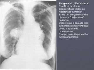 Dr. Emanuel R. Dantas
Alargamento hilar bilateral.
Este filme mostra as
características típicas de
hipertensão pulmonar.
Existe um alargamento hilar
bilateral e “podamento”
periférico.
Observe que o coração está
aumentado com o ventrículo
direito e sua saída
proeminentes.
Este pct possui hipertensão
pulmonar primária.
 