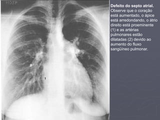 Dr. Emanuel R. Dantas
Defeito do septo atrial.
Observe que o coração
está aumentado, o ápice
está arredondando, o átrio
direito está proeminente
(1) e as artérias
pulmonares estão
dilatadas (2) devido ao
aumento do fluxo
sangüíneo pulmonar.
 