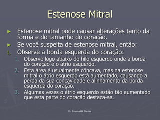 Dr. Emanuel R. Dantas
Estenose Mitral
► Estenose mitral pode causar alterações tanto da
forma e do tamanho do coração.
► Se você suspeita de estenose mitral, então:
1. Observe a borda esquerda do coração:
1. Observe logo abaixo do hilo esquerdo onde a borda
do coração é o átrio esquerdo.
2. Esta área é usualmente côncava, mas na estenose
mitral o átrio esquerdo está aumentado, causando a
perda da sua concavidade e alinhamento da borda
esquerda do coração.
3. Algumas vezes o átrio esquerdo estão tão aumentado
que esta parte do coração destaca-se.
 