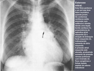 Dr. Emanuel R. Dantas
Estenose
mitral.
Este filme pertence
a um pct que teve
febre reumática
quando jovem.
Os contornos
cardíacos estão
anormais com
saliência à direita,
dando uma dupla
borda cardíaca (1),
proeminência do
apêndice atrial
esquerdo (2) e
elvação do brônquio
fonte esquerdo (3),
indicamendo
aumento do átrio
esquerdo.
A pressão atrial
esquerda está
elevada, produzindo
aumento da pressão
venosa pulmonar
com inversão do
fluxo sangüíneo e
linhas basais
septais de edema
intersticial
 