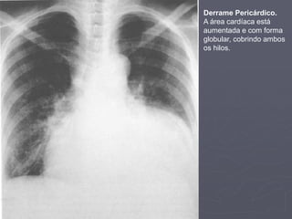 Dr. Emanuel R. Dantas
Derrame Pericárdico.
A área cardíaca está
aumentada e com forma
globular, cobrindo ambos
os hilos.
 