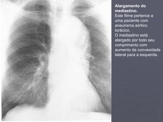 Dr. Emanuel R. Dantas
Alargamento do
mediastino.
Este filme pertence a
uma paciente com
aneurisma aórtico
torácico.
O mediastino está
alargado por todo seu
comprimento com
aumento da convexidade
lateral para a esquerda.
 
