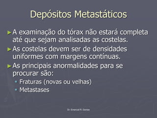 Dr. Emanuel R. Dantas
Depósitos Metastáticos
►A examinação do tórax não estará completa
até que sejam analisadas as costelas.
►As costelas devem ser de densidades
uniformes com margens contínuas.
►As principais anormalidades para se
procurar são:
▪ Fraturas (novas ou velhas)
▪ Metastases
 
