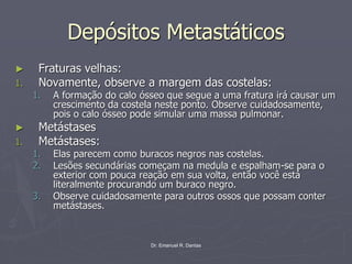 Dr. Emanuel R. Dantas
Depósitos Metastáticos
► Fraturas velhas:
1. Novamente, observe a margem das costelas:
1. A formação do calo ósseo que segue a uma fratura irá causar um
crescimento da costela neste ponto. Observe cuidadosamente,
pois o calo ósseo pode simular uma massa pulmonar.
► Metástases
1. Metástases:
1. Elas parecem como buracos negros nas costelas.
2. Lesões secundárias começam na medula e espalham-se para o
exterior com pouca reação em sua volta, então você está
literalmente procurando um buraco negro.
3. Observe cuidadosamente para outros ossos que possam conter
metástases.
 