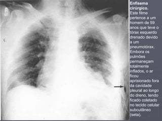 Dr. Emanuel R. Dantas
Enfisema
cirúrgico.
Este filme
pertence a um
homem de 59
anos que teve o
tórax esquerdo
drenado devido
a um
pneumotórax.
Embora os
pulmões
permaneçam
totalmente
inflados, o ar
ficou
aprisionado fora
da cavidade
pleural ao longo
do dreno, tendo
ficado coletado
no tecido celular
subcutâneo
(seta).
 