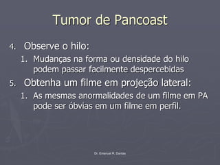Dr. Emanuel R. Dantas
Tumor de Pancoast
4. Observe o hilo:
1. Mudanças na forma ou densidade do hilo
podem passar facilmente despercebidas
5. Obtenha um filme em projeção lateral:
1. As mesmas anormalidades de um filme em PA
pode ser óbvias em um filme em perfil.
 