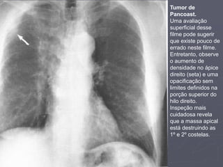 Dr. Emanuel R. Dantas
Tumor de
Pancoast.
Uma avaliação
superficial desse
filme pode sugerir
que existe pouco de
errado neste filme.
Entretanto, observe
o aumento de
densidade no ápice
direito (seta) e uma
opacificação sem
limites definidos na
porção superior do
hilo direito.
Inspeção mais
cuidadosa revela
que a massa apical
está destruindo as
1º e 2º costelas.
 