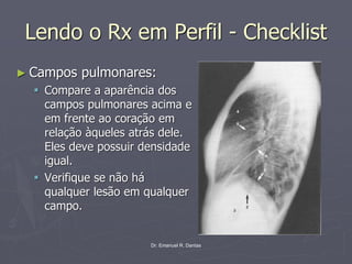 Dr. Emanuel R. Dantas
Lendo o Rx em Perfil - Checklist
► Campos pulmonares:
▪ Compare a aparência dos
campos pulmonares acima e
em frente ao coração em
relação àqueles atrás dele.
Eles deve possuir densidade
igual.
▪ Verifique se não há
qualquer lesão em qualquer
campo.
 