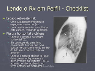 Dr. Emanuel R. Dantas
Lendo o Rx em Perfil - Checklist
► Espaço retroesternal:
▪ Olhe cuidadosamente para o
espaço retroesternal (4).
▪ Uma massa anterior irá obliterar
este espaço, tornando-o branco.
► Fissura horizontal e oblíqua:
▪ Cheque a posição da fissura
horizontal (5).
▪ Ela corresponde uma linha
parcamente branca que deve
passar horizontalmente do centro
do hilo até a parede torácica
anterior.
▪ Cheque a fissura oblíqua (6) que
deve passar obliquamente e
inferiormente da vértebra T4/T5,
através do hilo, acabando no
terço anterior do diafragma.
 