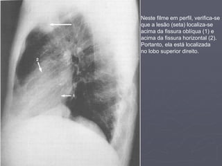 Dr. Emanuel R. Dantas
Neste filme em perfil, verifica-se
que a lesão (seta) localiza-se
acima da fissura oblíqua (1) e
acima da fissura horizontal (2).
Portanto, ela está localizada
no lobo superior direito.
 