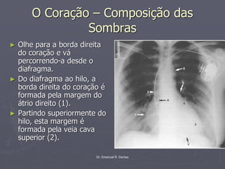 Dr. Emanuel R. Dantas
O Coração – Composição das
Sombras
► Olhe para a borda direita
do coração e vá
percorrendo-a desde o
diafragma.
► Do diafragma ao hilo, a
borda direita do coração é
formada pela margem do
átrio direito (1).
► Partindo superiormente do
hilo, esta margem é
formada pela veia cava
superior (2).
 