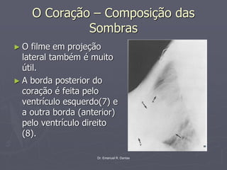 Dr. Emanuel R. Dantas
O Coração – Composição das
Sombras
► O filme em projeção
lateral também é muito
útil.
► A borda posterior do
coração é feita pelo
ventrículo esquerdo(7) e
a outra borda (anterior)
pelo ventrículo direito
(8).
 