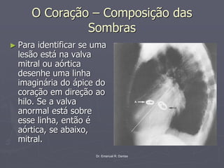 Dr. Emanuel R. Dantas
O Coração – Composição das
Sombras
► Para identificar se uma
lesão está na valva
mitral ou aórtica
desenhe uma linha
imaginária do ápice do
coração em direção ao
hilo. Se a valva
anormal está sobre
esse linha, então é
aórtica, se abaixo,
mitral.
 