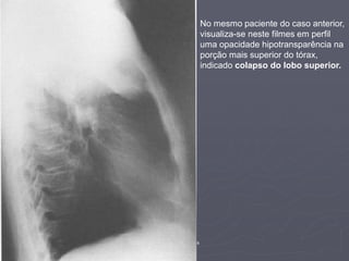 Dr. Emanuel R. Dantas
No mesmo paciente do caso anterior,
visualiza-se neste filmes em perfil
uma opacidade hipotransparência na
porção mais superior do tórax,
indicado colapso do lobo superior.
 