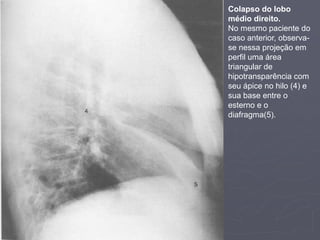 Dr. Emanuel R. Dantas
Colapso do lobo
médio direito.
No mesmo paciente do
caso anterior, observa-
se nessa projeção em
perfil uma área
triangular de
hipotransparência com
seu ápice no hilo (4) e
sua base entre o
esterno e o
diafragma(5).
 