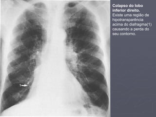 Dr. Emanuel R. Dantas
Colapso do lobo
inferior direito.
Existe uma região de
hipotransparência
acima do diafragma(1)
causando a perda do
seu contorno.
 