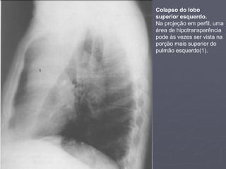 Dr. Emanuel R. Dantas
Colapso do lobo
superior esquerdo.
Na projeção em perfil, uma
área de hipotransparência
pode às vezes ser vista na
porção mais superior do
pulmão esquerdo(1).
 