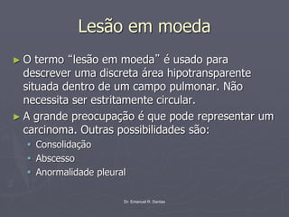 Dr. Emanuel R. Dantas
Lesão em moeda
► O termo “lesão em moeda” é usado para
descrever uma discreta área hipotransparente
situada dentro de um campo pulmonar. Não
necessita ser estritamente circular.
► A grande preocupação é que pode representar um
carcinoma. Outras possibilidades são:
▪ Consolidação
▪ Abscesso
▪ Anormalidade pleural
 