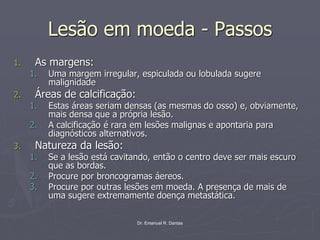 Dr. Emanuel R. Dantas
Lesão em moeda - Passos
1. As margens:
1. Uma margem irregular, espiculada ou lobulada sugere
malignidade
2. Áreas de calcificação:
1. Estas áreas seriam densas (as mesmas do osso) e, obviamente,
mais densa que a própria lesão.
2. A calcificação é rara em lesões malignas e apontaria para
diagnósticos alternativos.
3. Natureza da lesão:
1. Se a lesão está cavitando, então o centro deve ser mais escuro
que as bordas.
2. Procure por broncogramas áereos.
3. Procure por outras lesões em moeda. A presença de mais de
uma sugere extremamente doença metastática.
 