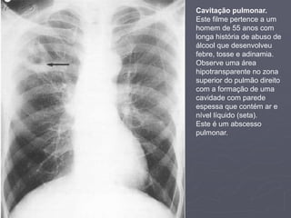 Dr. Emanuel R. Dantas
Cavitação pulmonar.
Este filme pertence a um
homem de 55 anos com
longa história de abuso de
álcool que desenvolveu
febre, tosse e adinamia.
Observe uma área
hipotransparente no zona
superior do pulmão direito
com a formação de uma
cavidade com parede
espessa que contém ar e
nível líquido (seta).
Este é um abscesso
pulmonar.
 