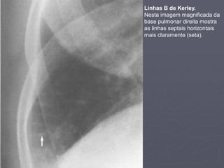 Dr. Emanuel R. Dantas
Linhas B de Kerley.
Nesta imagem magnificada da
base pulmonar direita mostra
as linhas septais horizontais
mais claramente (seta).
 