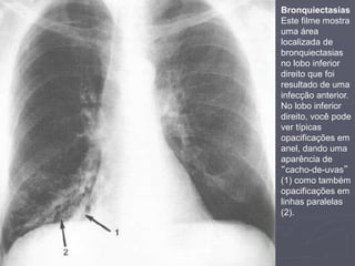 Dr. Emanuel R. Dantas
Bronquiectasias
Este filme mostra
uma área
localizada de
bronquiectasias
no lobo inferior
direito que foi
resultado de uma
infecção anterior.
No lobo inferior
direito, você pode
ver típicas
opacificações em
anel, dando uma
aparência de
“cacho-de-uvas”
(1) como também
opacificações em
linhas paralelas
(2).
 