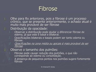 Dr. Emanuel R. Dantas
Fibrose
1. Olhe para Rx anteriores, pois a fibrose é um processo
crônico, que se presente anteriormente, o achado atual é
muito mais provável de ser fibrose
2. Distribuição da opacidade:
1. Observar a distribuição pode ajudar a diferenciar fibrose de
edema, já que este é basal e bilateral.
2. Opacificações bilaterais e basais podem ser tanto edema ou
fibrose.
3. Opacificações na zona média ou apicais é mais provável de ser
fibrose.
3. Observe o tamanho dos pulmões:
1. Fibrose pode causar redução dos pulmões, o que não
corresponde ao edema ou consolidação.
2. A presença de pequenos pontos nos pulmões sugere fortemente
fibrose
 