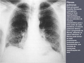 Dr. Emanuel R. Dantas
Fibrose
pulmonar.
Este pct possui
alveolite fibrosante
criptogênica.
Observe finas
opacificações
reticulonodulares
que se estendem de
maneira
característica para a
linha axilar de cada
hemitórax. O volume
pulmonar diminui
com a progressão da
fibrose, afetando os
lobos inferiores. A
fibrose pode tornar-
se mais
proeminente,
evoluindo para o
faveolamento, que
consiste de
numerosas
opacificações em
anel.
 
