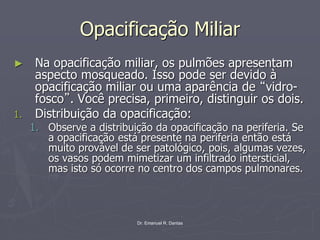 Dr. Emanuel R. Dantas
Opacificação Miliar
► Na opacificação miliar, os pulmões apresentam
aspecto mosqueado. Isso pode ser devido à
opacificação miliar ou uma aparência de “vidro-
fosco”. Você precisa, primeiro, distinguir os dois.
1. Distribuição da opacificação:
1. Observe a distribuição da opacificação na periferia. Se
a opacificação está presente na periferia então está
muito provável de ser patológico, pois, algumas vezes,
os vasos podem mimetizar um infiltrado intersticial,
mas isto só ocorre no centro dos campos pulmonares.
 