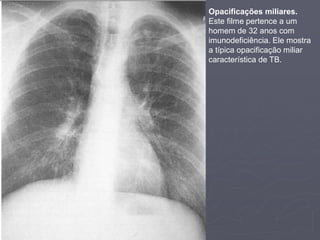 Dr. Emanuel R. Dantas
Opacificações miliares.
Este filme pertence a um
homem de 32 anos com
imunodeficiência. Ele mostra
a típica opacificação miliar
característica de TB.
 