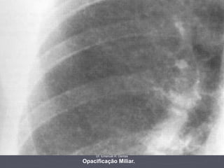 Dr. Emanuel R. Dantas
Opacificação Miliar.
 