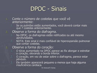Dr. Emanuel R. Dantas
DPOC - Sinais
1. Conte o número de costelas que você vê
anteriormente:
1. Se os pulmões estão aumentados, você deverá contar mais
que 7 costelas anteriormente.
2. Observe a forma do diafragma.
1. Na DPOC, os diafragmas estão retificados ou até mesmo
aprofundados.
2. NOTA: Este sinal é mais confiável de hiperexpansão pulmonar
que contar costelas.
3. Observe a forma do coração:
1. O tórax aumentado na DPOC parece ao Rx alongar e estreitar
o coração, elevando a borda inferior.
2. O coração, em vez de estar sobre o diafragma, parece estar
pêndulo.
3. Ele também aparecerá pequeno a menos que haja alguma
insuficiência cardíaca.
 