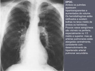 Dr. Emanuel R. Dantas
DPOC.
Ambos os pulmões
aparecem
hipertransparentes e
aumentados de volume.
Os hemidiafragmas estão
retificados e existem
bolhas no terço médio de
ambos os hemitórax.
Poucos vasos sangüíneos
são visíveis na periferia,
especialmente no 1/3
médio e superior, mas as
artérias pulmonares estão
alargadas centralmente,
consistente com
desenvolvimento de
hipertensão arterial
pulmonar secundária.
 