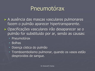 Dr. Emanuel R. Dantas
Pneumotórax
► A ausência das mascas vasculares pulmonares
fazem o pulmão aparecer hipertransparente.
► Opacificações vasculares irão desaparecer se o
pulmão for substituído por ar, sendo as causas:
▪ Pneumotórax
▪ Bolhas
▪ Doença cística do pulmão
▪ Tromboembolismo pulmonar, quando os vasos estão
desprovidos de sangue.
 