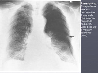 Dr. Emanuel R. Dantas
Pneumotórax
Este paciente
teve um
pneumotórax
à esquerda
com colapso
do pulmão
esquerdo.
Você pode ver
a margem
pulmonar
(seta).
 