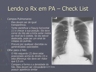 Dr. Emanuel R. Dantas
Lendo o Rx em PA – Check List
1. Campos Pulmonares:
1. Eles devem ser de igual
transparência.
2. Tente identificar a fissura horizontal
(1) e checar a sua posição. Ela deve
correr do hilo até a linha axilar média
ao nível da 6 costela. Se ela estiver
deslocada, pode ser um sinal de
colapso do pulmão.
3. Procure por qualquer discretas ou
generalizadas opacidades
2. Olhe para o hilo:
1. O hilo esquerdo (2) deve estar
posicionado acima do direito (3) e
esta diferença não deve ser maior
que 2,5 cm.
2. Compare a forma e a densidade do
hilo. Eles devem ser côncavos e
possuir aparência similar
 