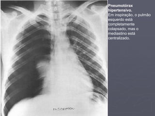 Dr. Emanuel R. Dantas
Pneumotórax
hipertensivo.
Em inspiração, o pulmão
esquerdo está
completamente
colapsado, mas o
mediastino está
centralizado.
 