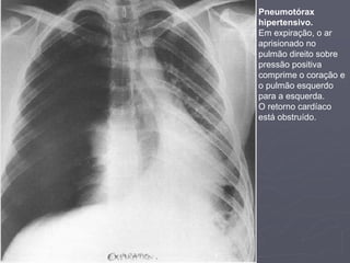 Dr. Emanuel R. Dantas
Pneumotórax
hipertensivo.
Em expiração, o ar
aprisionado no
pulmão direito sobre
pressão positiva
comprime o coração e
o pulmão esquerdo
para a esquerda.
O retorno cardíaco
está obstruído.
 