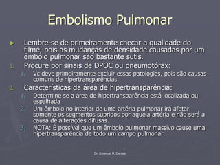 Dr. Emanuel R. Dantas
Embolismo Pulmonar
► Lembre-se de primeiramente checar a qualidade do
filme, pois as mudanças de densidade causadas por um
êmbolo pulmonar são bastante sutis.
1. Procure por sinais de DPOC ou pneumotórax:
1. Vc deve primeiramente excluir essas patologias, pois são causas
comuns de hipertransparências
2. Características da área de hipertransparência:
1. Determine se a área de hipertransparência está localizada ou
espalhada
2. Um êmbolo no interior de uma artéria pulmonar irá afetar
somente os segmentos supridos por aquela artéria e não será a
causa de alterações difusas.
3. NOTA: É possível que um êmbolo pulmonar massivo cause uma
hipertransparência de todo um campo pulmonar.
 
