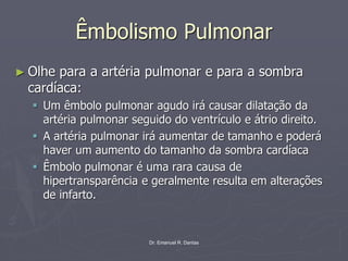 Dr. Emanuel R. Dantas
Êmbolismo Pulmonar
► Olhe para a artéria pulmonar e para a sombra
cardíaca:
▪ Um êmbolo pulmonar agudo irá causar dilatação da
artéria pulmonar seguido do ventrículo e átrio direito.
▪ A artéria pulmonar irá aumentar de tamanho e poderá
haver um aumento do tamanho da sombra cardíaca
▪ Êmbolo pulmonar é uma rara causa de
hipertransparência e geralmente resulta em alterações
de infarto.
 