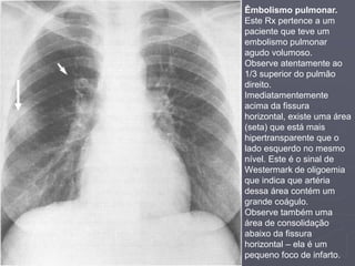 Dr. Emanuel R. Dantas
Êmbolismo pulmonar.
Este Rx pertence a um
paciente que teve um
embolismo pulmonar
agudo volumoso.
Observe atentamente ao
1/3 superior do pulmão
direito.
Imediatamentemente
acima da fissura
horizontal, existe uma área
(seta) que está mais
hipertransparente que o
lado esquerdo no mesmo
nível. Este é o sinal de
Westermark de oligoemia
que indica que artéria
dessa área contém um
grande coágulo.
Observe também uma
área de consolidação
abaixo da fissura
horizontal – ela é um
pequeno foco de infarto.
 