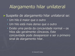 Dr. Emanuel R. Dantas
Alargamento hilar unilateral
►Suspeite de alargamento hilar unilateral se:
▪ Um hilo é maior que o outro
▪ Um hilo está mais denso que o outro
▪ Existe uma perda da concavidade normal – os
hilos são geralmente côncavos. Este
concavidade pode desaparecer e ser o primeiro
sinal de alargamento hilar.
 