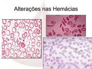 Alterações nas Hemácias




                    Profa. Eloá Medeiros
                           01/2008
 
