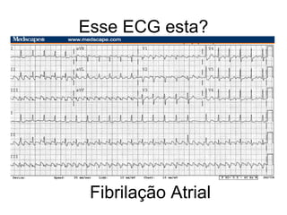 Esse ECG esta? Fibrilação Atrial 