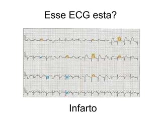 Esse ECG esta? Infarto  