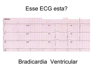 Esse ECG esta? Bradicardia  Ventricular  